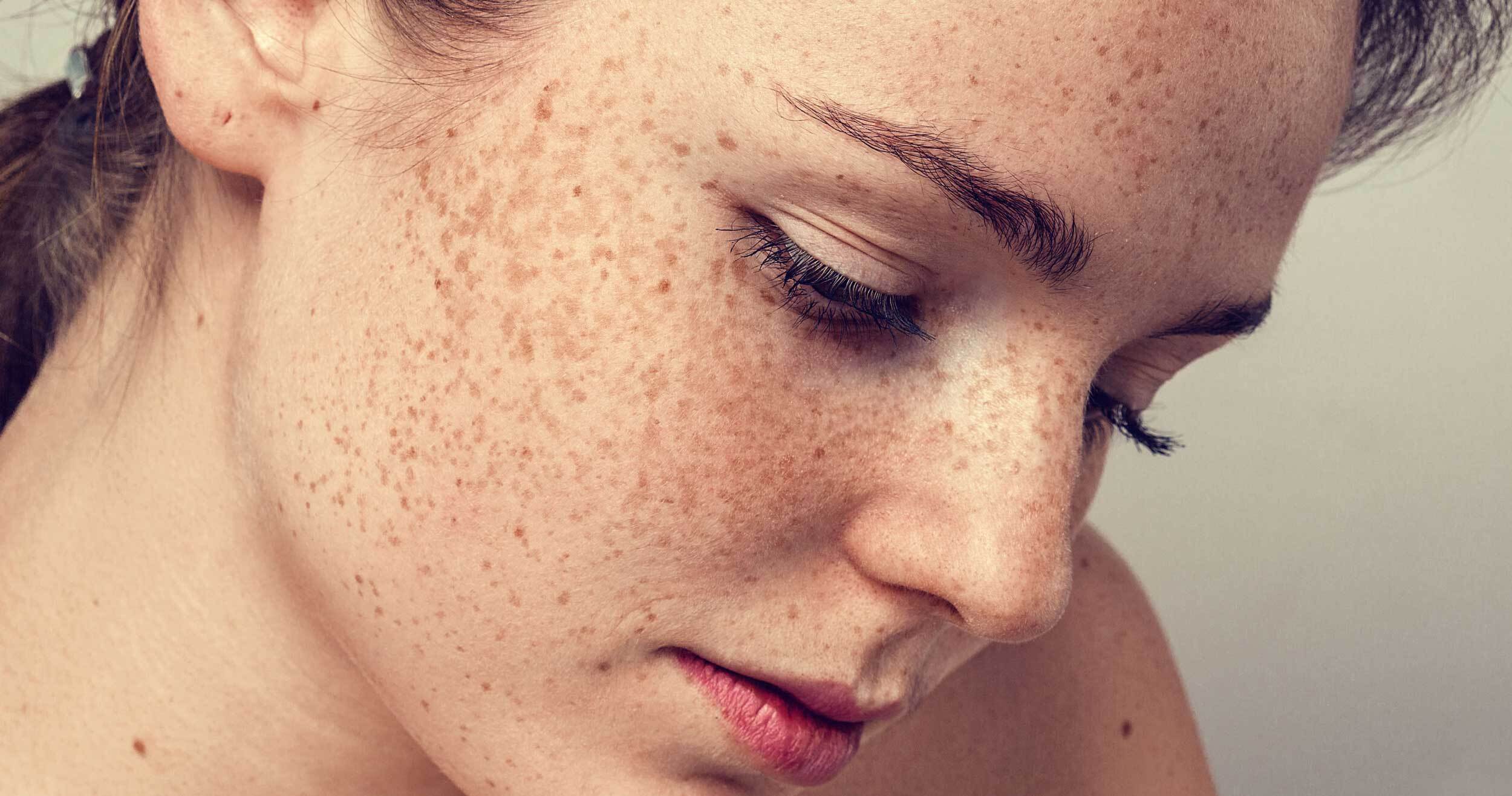 everything-you-need-to-know-about-freckles-yours-simplified